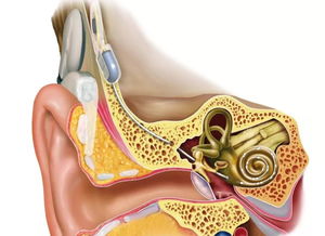 梦到人工耳蜗出血什么意思,人工耳蜗有哪些利弊呢？