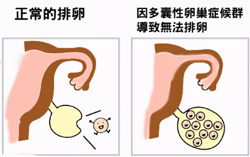 做梦梦到多囊代表什么,梦见自已得了卵巢囊肿 而且还做了微创是怎么回事